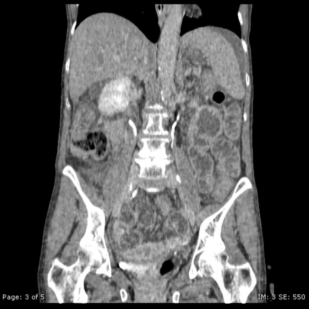Fig. 22: Feacal impaction: CT MPR coronal view shows a voluminous fecolith