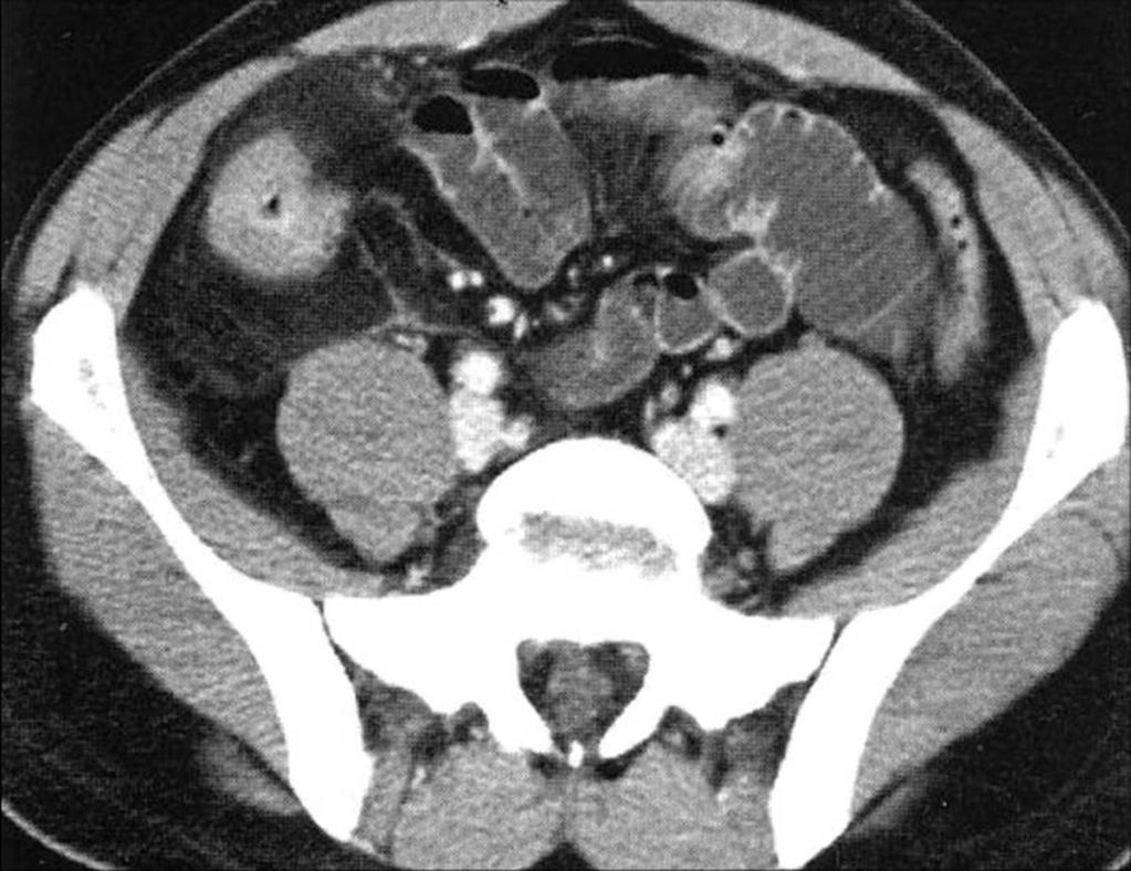 25: Mechanical small bowel obstruction of the ileum in a patient with Crohn disease.