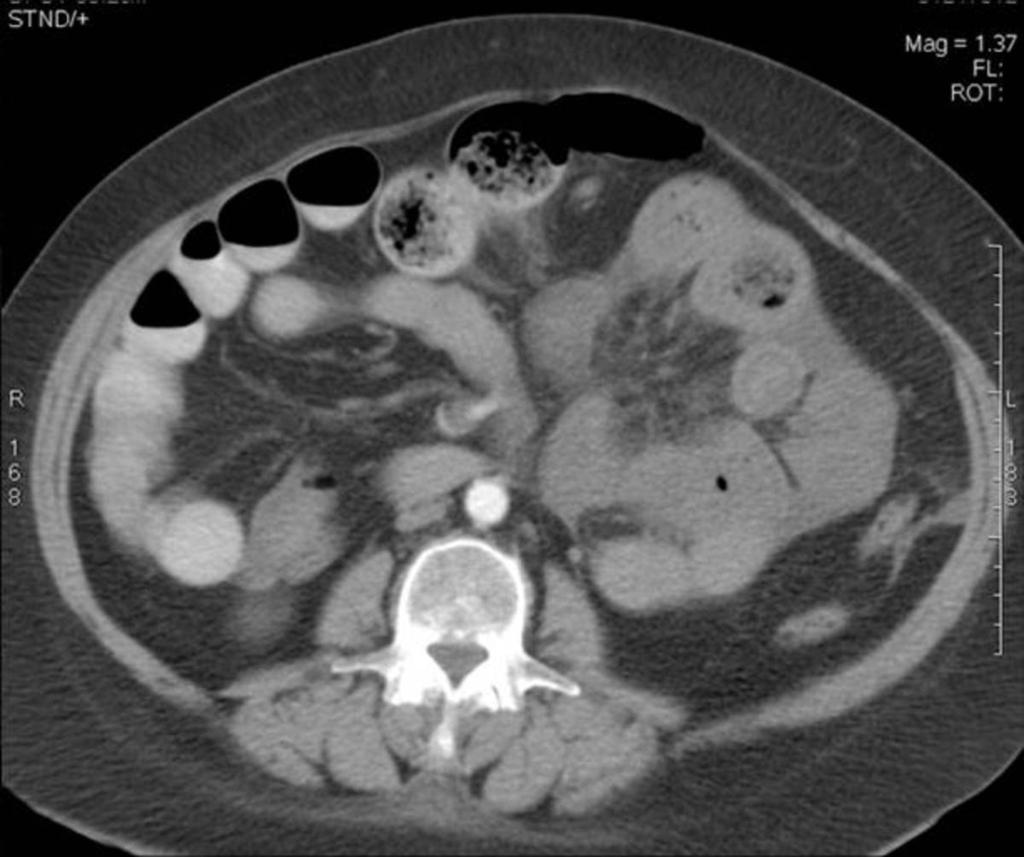 Fig. 1: Closed-loop obstruction secondary to internal hernia: CT scan shows a radial distribution of small