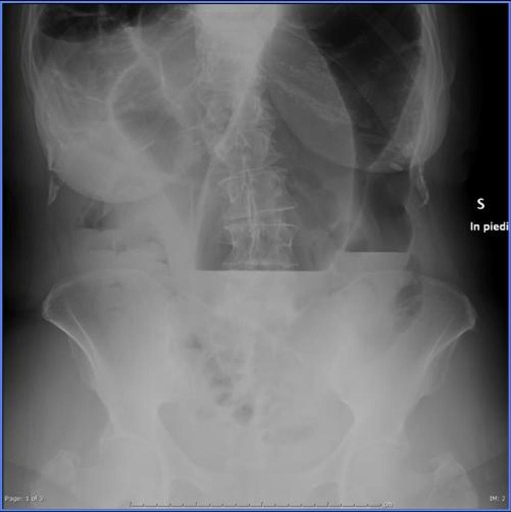 Fig. 2: Plain abdominal radiograph shows distension of