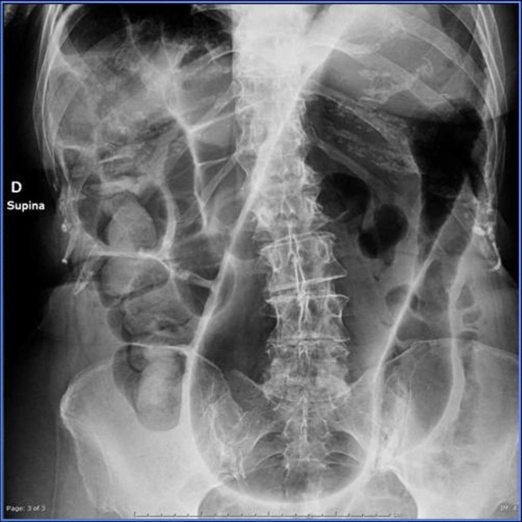 Fig. 3: Plain abdominal radiograph shows distension of
