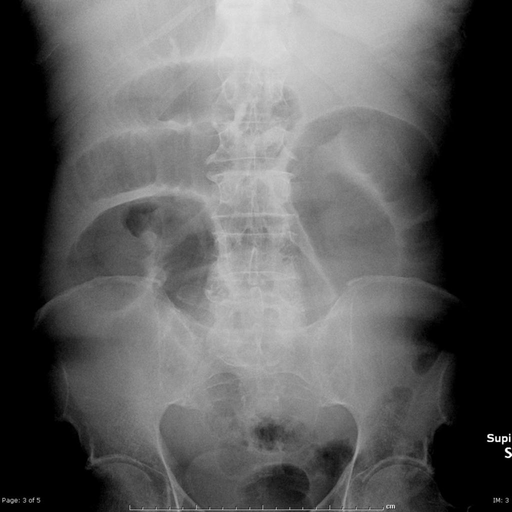 Fig. 4: Plain abdominal radiograph shows distension of