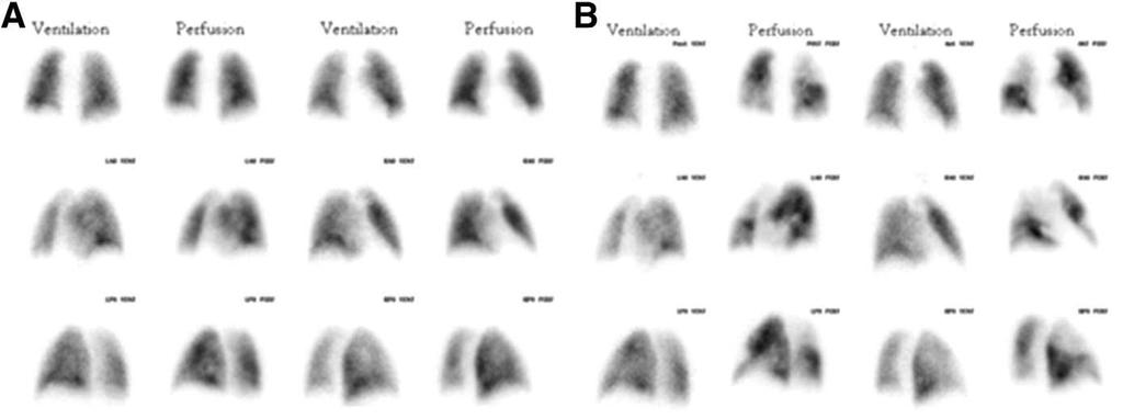 Ventilation Perfusion Study (A) A normal ventilation and perfusion lung scan showing uniform uptake of both Technegas and [99mTc]-MAA (macro