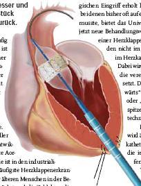 Aortic valve implantation using the femoral and apical access: a single center experience. R. Hoffmann, K.