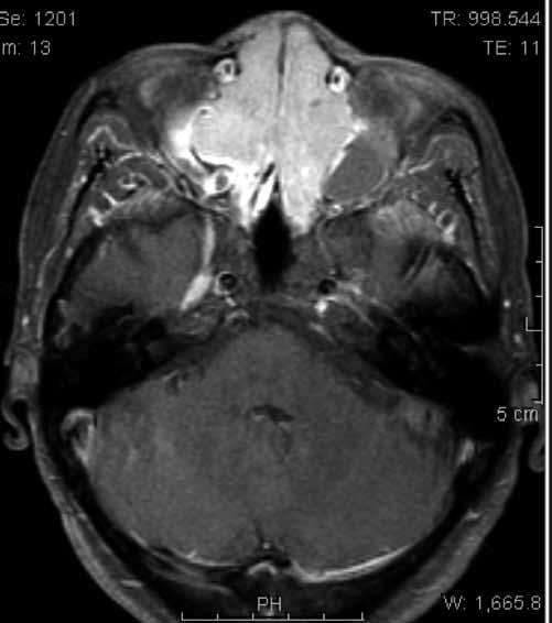 She underwent surgical resection of the nasal mass lesion, and histopathological examination revealed diffuse infiltration of pleomorphic inflammatory cells, including lymphocytes, plasma cells and