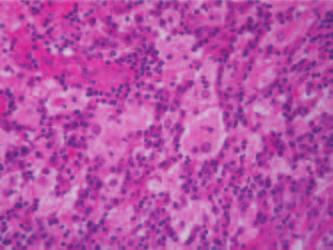 Extranodal Rosai-Dorfman disease 93 lymphoproliferative disorder with unknown etiology.