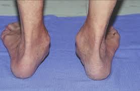 many toes sign Achilles