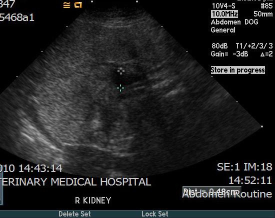 Figure 3: Right kidney showing renal pelvis dilation Ultrasound Description: The kidneys were irregular and inhomogenous (with an increase in echogenicity greater than that of the spleen)