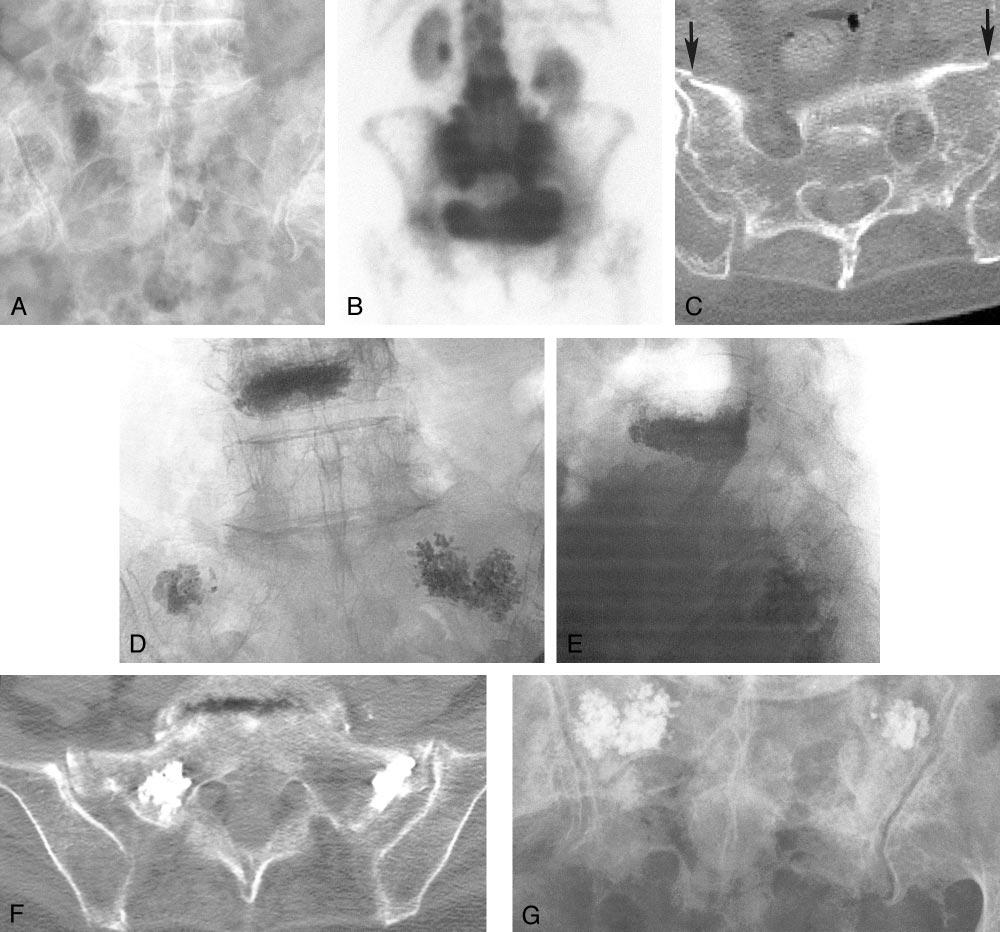 1004 POMMERSHEIM AJNR: 24, May 2003 FIG 1. Case 1, a 76-year-old woman with low back pain. A, Pelvic radiograph shows degenerative lumbar changes. Note, however, that the sacrum is unremarkable.