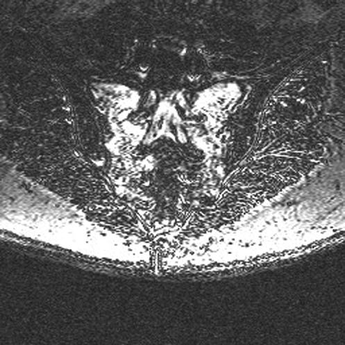 1636 Spine Volume 32 Number 15 2007 Figure 1. Sacral MRI through the coronal plane highlighting increased T2-weighted signal in both sacral ala indicating sacral edema.