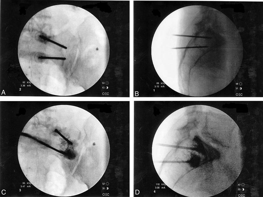 Percutaneous Sacroplasty Frey et al 1637 Figure 3. Anteroposterior (A, top) and lateral (B, bottom) fluoroscopic views of two 13-gauge bone trochars in the right sacral ala.