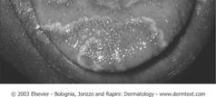 Geographic tounge Oral Diseases Hairy Tongue