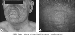 Seborrheic Dermatitis Differentiated from Atopic Eczema Lichen Simplex Chronicus Differentiated from Neruodermatitis from