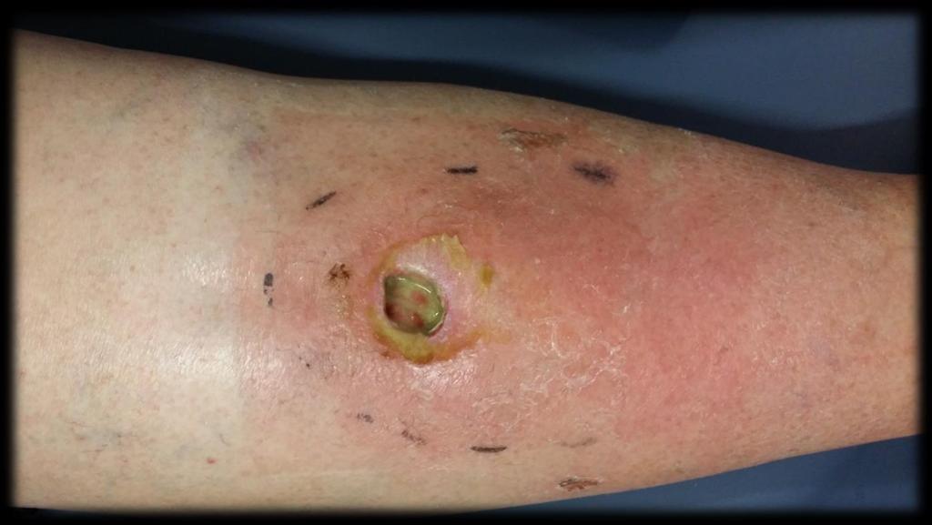 Figure 1: Right tibial ulcer associated