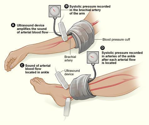 Ankle Brachial Index ABI = P Leg P Arm P Leg = Highest of the dorsalis pedis and posterior tibial systolic pressure P Arm = Highest of the left and right