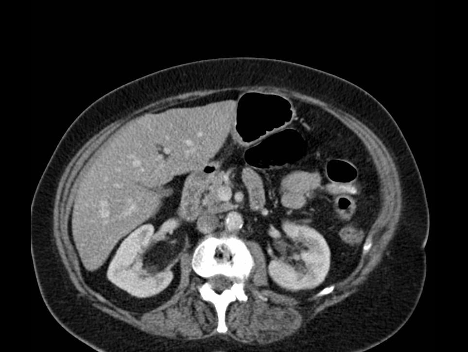 FIGURE 1. CT of the abdomen, demonstrating a right-sided tumour invading the renal vein. FIGURE 2. CT of a soft tissue mass seen in the left kidney.