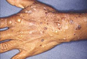 Malabsorption and Skin Disease