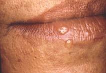 changes Hyperpigmentation Skin texture