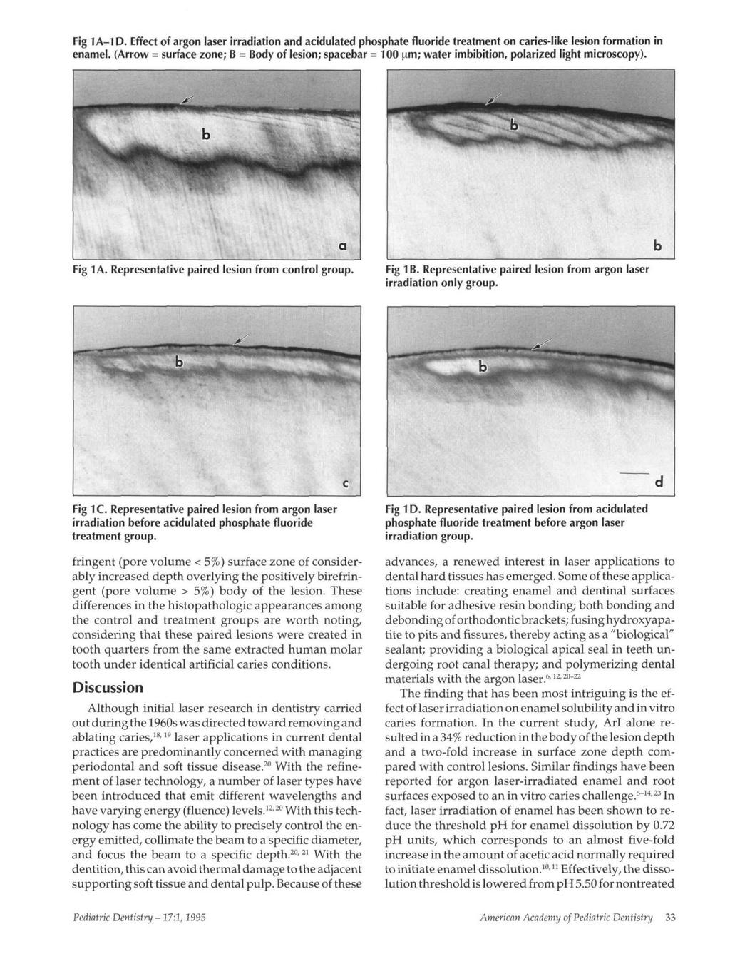 Fig 1A-1D. Effect of argon laser irradiation and acidulated phosphate fluoride treatment on caries-like lesion formation in enamel.