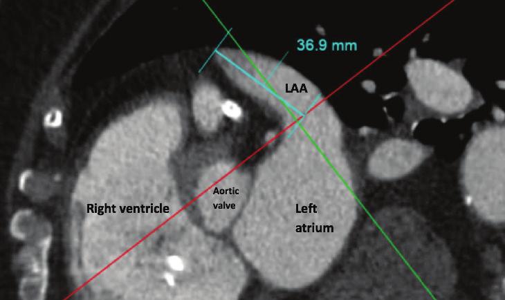 Identifying the maximal length to the LAA landing zone to distal tip of the main lobe of the LAA TABLE 1.