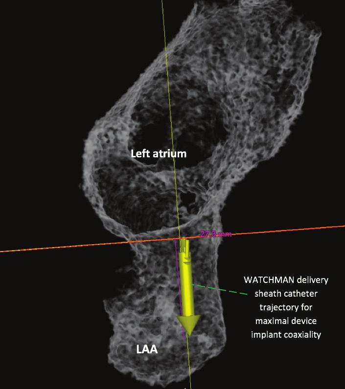 LAA. Remove the aortic root from the 3D volume.