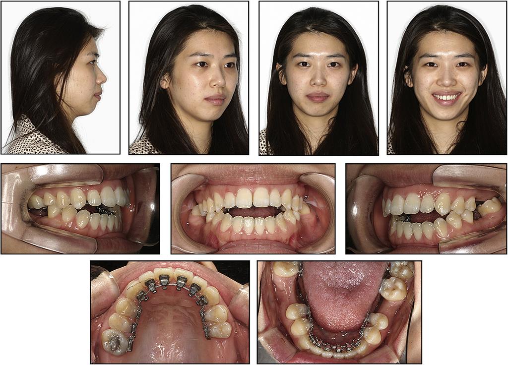 Jung, Baik, and Ahn S129 Fig 5. Presurgical facial and intraoral photographs.