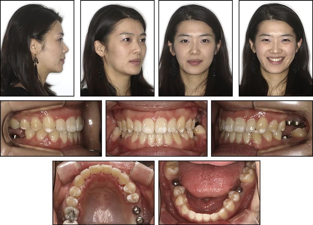 Jung, Baik, and Ahn S131 Fig 8. Posttreatment facial and intraoral photographs. Fig 9.