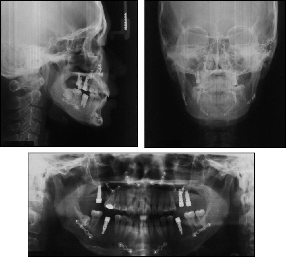 S132 Jung, Baik, and Ahn Fig 10. Posttreatment radiographs. profile and lip support were improved, and the mentalis hyperactivity was reduced.
