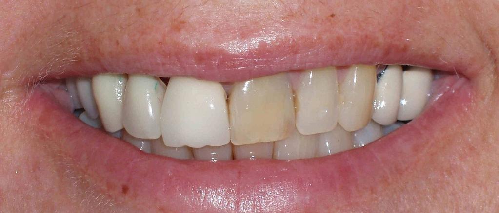 CASE STUDY BEFORE AFTER PATIENT NAME: HELEN MORTON DENTIST: JEREMY TREATMENT: IMPLANTS AND SMILE DESIGN WITH CROWNS Testimonial: I moved to Jersey had visited my Dentist as I had a years previously