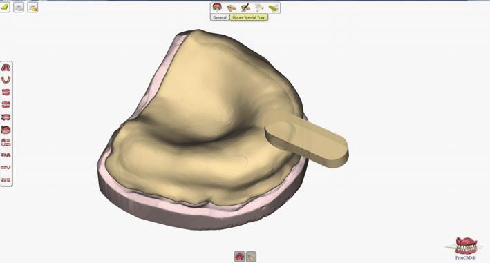 For the primary casts, conventional impressions using alginate (Alginoplast, regular set; Heraeus Kulzer GmbH) were made for subsequent scanning and digital designed special trays (first clinical