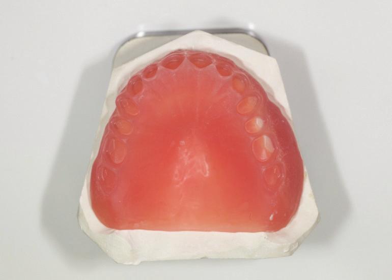 4 Case Reports in Dentistry Figure 11: Denture bases. Figure 13: Clinical photos of the final denture. Figure 12: Final denture.