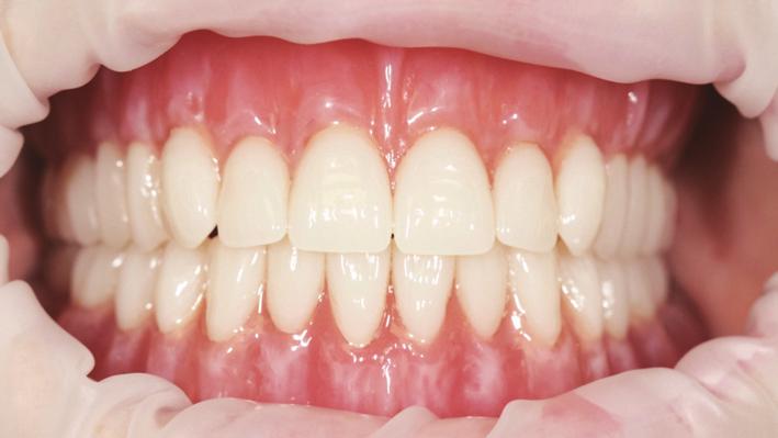 accuracy in denture fit, and easier duplication of dentures [2 5]. The use of CAD/CAM to support the manufacture of removable dentures has been previously reported with different concepts.