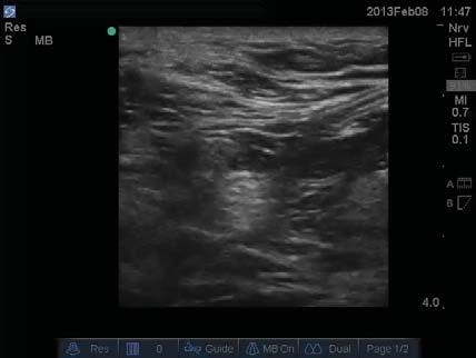 Popliteal Popliteal Ultrasound greatly reduces the traditional complications of intravascular and intra-neural injections When using nerve