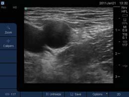 groin appear as nerves ; scanning proximal and distal will help distinguish the lymph node as they are