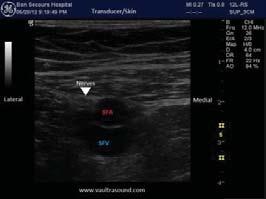 superficial femoral artery and vein appear as hypoechoic circles bordered superiorly by the sartorius, laterally by the vastus medialis and medially by