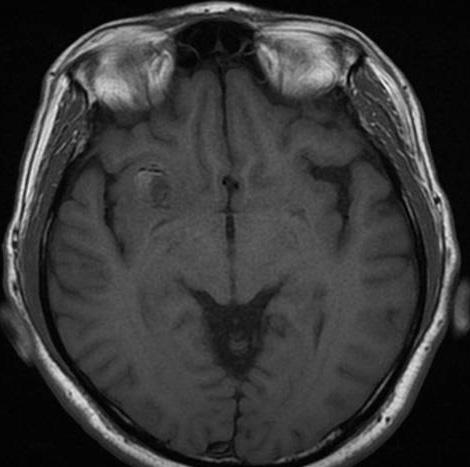 or ganglioglioma. Fig. 1. Computed tomography (CT) scan of brain.