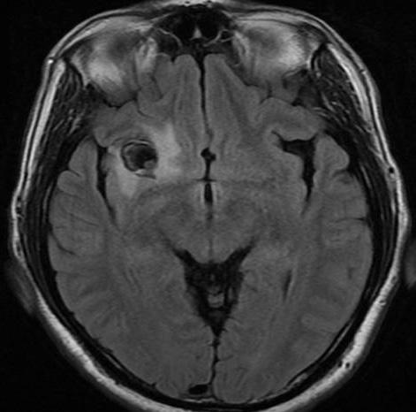 frontal area is observed in initial CT, 7 years ago.