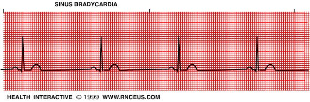 3- Sinus Bradycardia 14 Same as SR but the rate is < 60 Regular