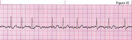 1- Atrial Fibrillation 16 Always irregular No P wave (