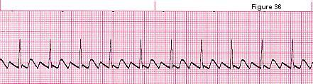 2- Atrial Flutter 17 Mostly regular, but it can be irregular No P