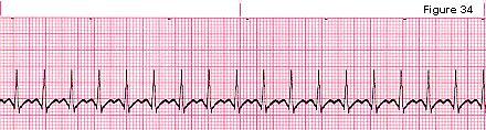 3- Atrial Tachycardia 18 Some times it is called Supraventricular Tachycardia (SVT).