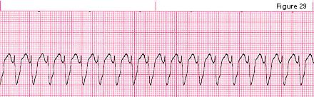 6- Ventricular Tachycardia ( V-tach.) A whole strip with PVCs.
