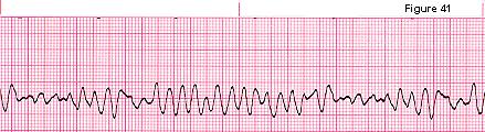 7- ventricular Fibrillation No P waves, No QRS, only