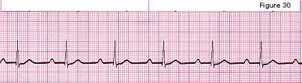 1-1st Degree AV Block It looks like the sinus rhythm but with prolonged P-R interval.