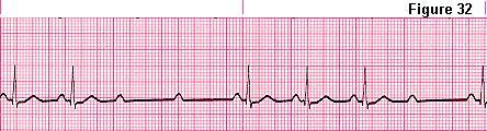 2-2nd Degree AV Block a- Mobitz II Identical P waves, Not every P is followed by a QRS.