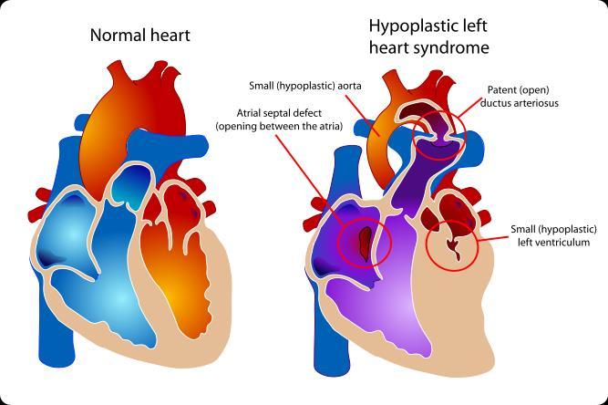 because the ductus arteriosus must supply circulation to the area distal to the area of aortic arch hypoplasia, the
