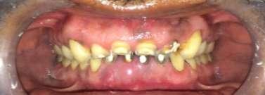 of pain in mandibular both central and lateral incisor.