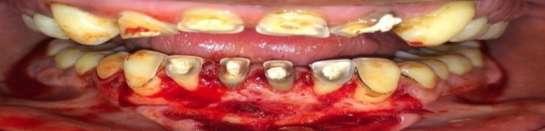 in relationof mandibular anterior tooth resion both central