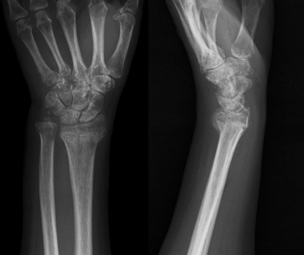 J Orthopaed Traumatol (2017) 18:37 42 39 Fig. 1 A 69-year-old female patient. Radiographs of left wrist at 6 weeks after injury show fracture of the distal radius with malalignment Fig.