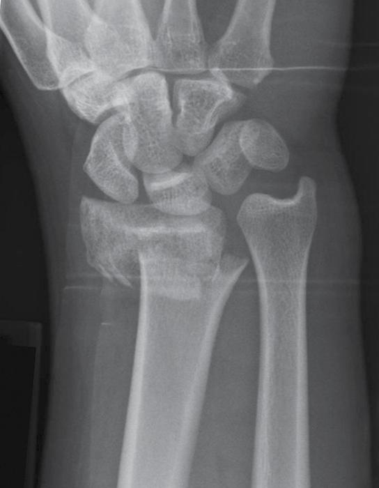 Indications & Contraindications Indications Unstable extraarticular dorsally displaced distal radius fracture.(figures 2A,B) Displaced radial styloid fractures.
